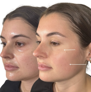 PDGF Under eye Treatment - Nashville's Best in Skin Rejuvenation