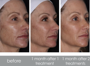 PDGF Microneedling Nashville's Best in Skin Rejuvenation 