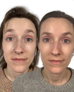 forehead botox - upper face