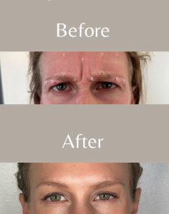 glabella or 11s botox - upper face