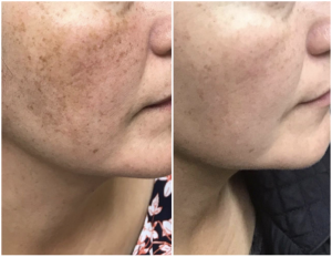 before and after of a pico laser skin rejuvenation treatment 