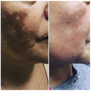 Before and After Pico laser treatment