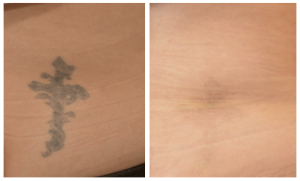 Tattoo Removal with Pico Laser